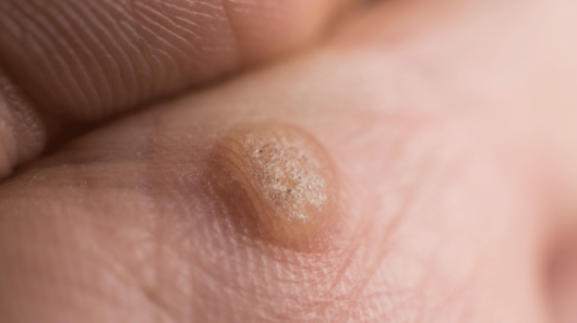 Are Skin Warts Precancerous? Why Early Identification and Removal Matter