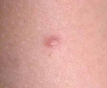 Dermatofibroma A Common Skin Lump That’s Usually Harmless